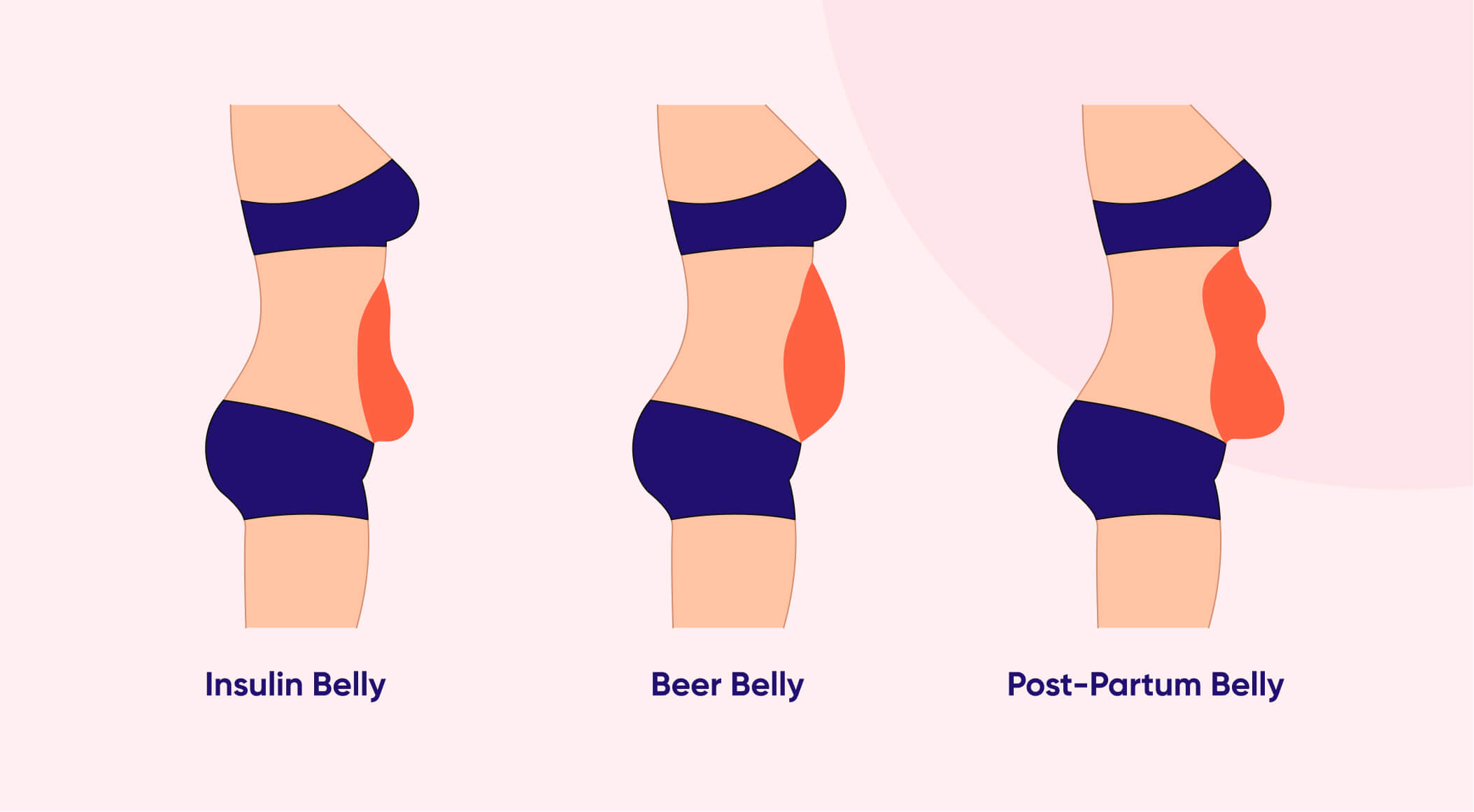 Types of bellies: insulin, beer and postpartum belly